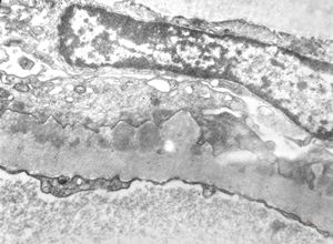 M,39y. | membranous glomerulopathy